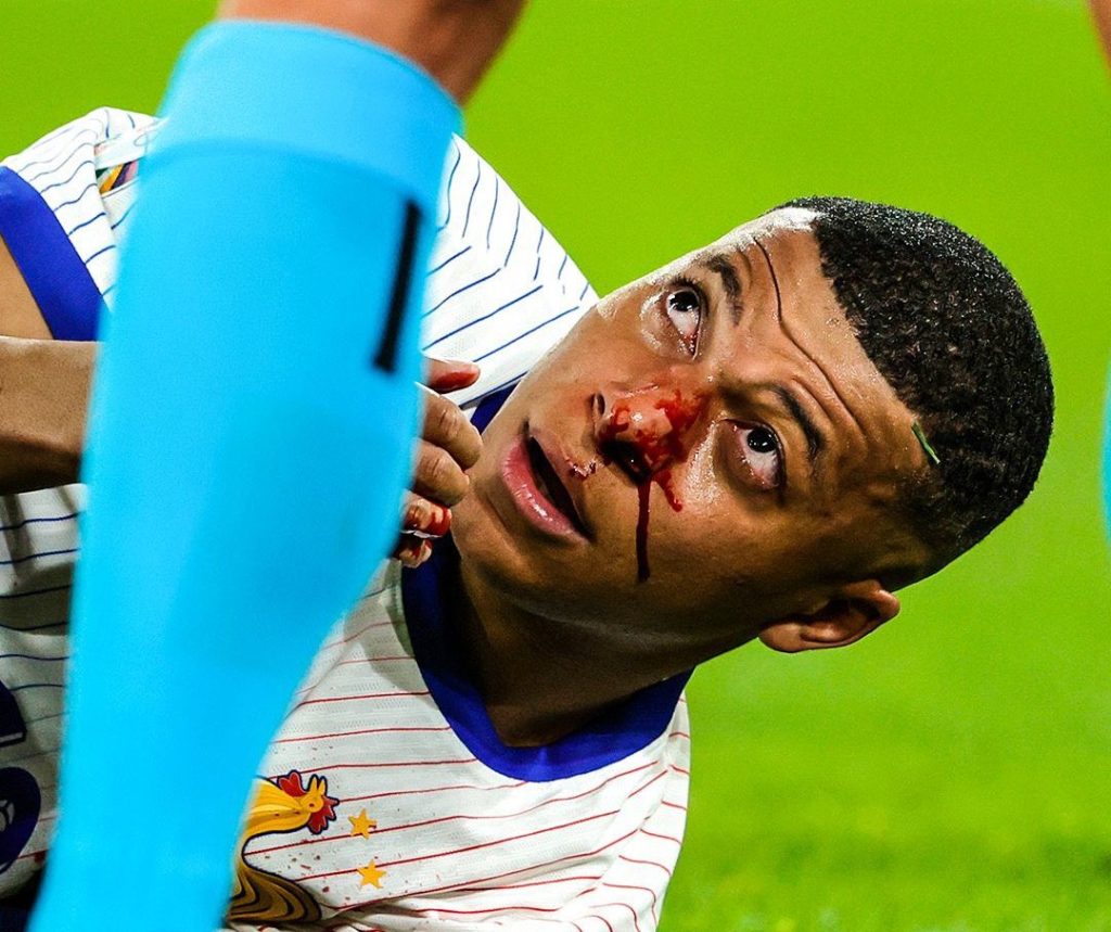 Euro 2024 Mbappe Suffers Broken Nose OtownGist Media